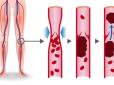 Це варто знати! Як проявляється тромбоз і що робити, якщо утворився тромб